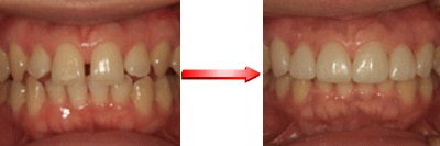 ラミネートべニアによる審美歯科治療