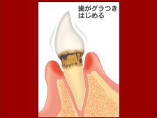 中度歯周病の図