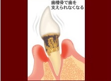 重度歯周病の図